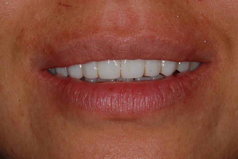 Closeup image of a patient's teeth after the New Teeth in One Day treatment.