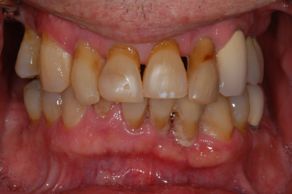Closeup image of a patient's teeth before the New Teeth in One Day treatment.
