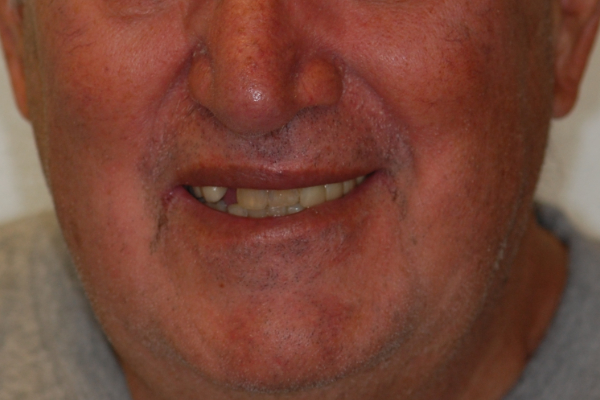 Closeup image of a patient's teeth before the New Teeth in One Day treatment.
