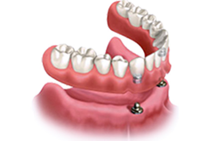 Implant-supported snap-in denture