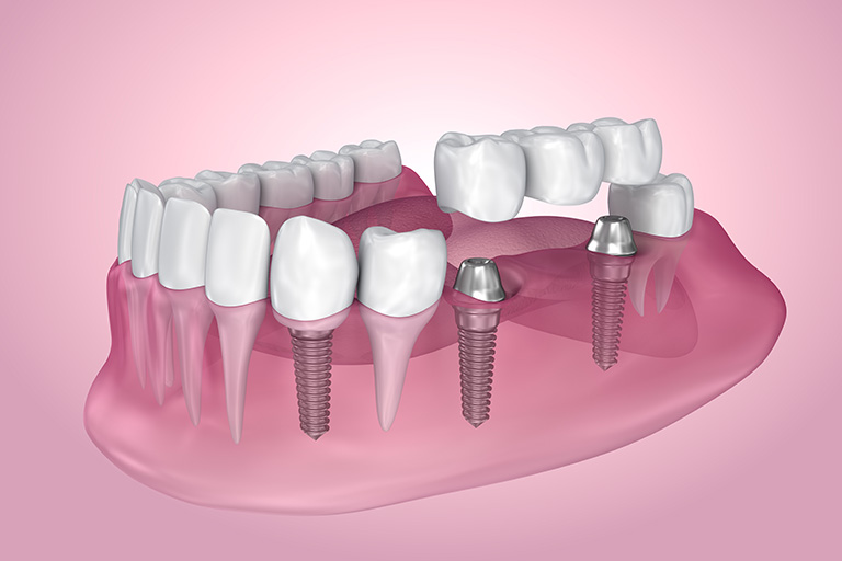 Dental implant and implant-supported bridge